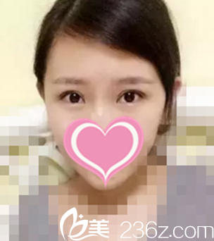 术后20天恢复效果 术后20天恢复效果