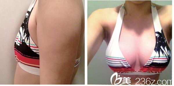 郑景仁院长假体隆胸案例 郑景仁院长假体隆胸案例