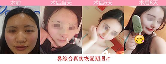 合肥崔向葵整形整形怎么样？看鼻综合案例对比图