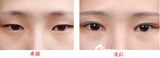 医生崔向葵做双眼皮好吗？双眼皮整形案例对比图展示