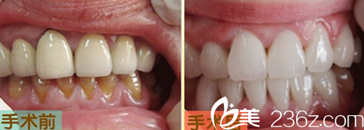 口腔医生崔莹莹超声波洗牙+牙齿纠正案例