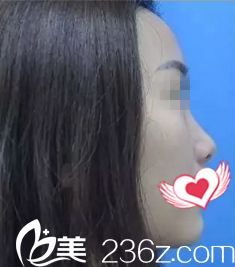 术前侧面照 术前侧面照