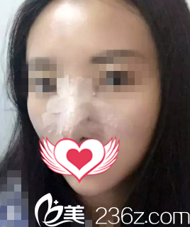 术后天照 术后天照