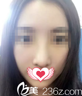 术后一周拆线 术后一周拆线