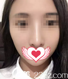 术后20天效果 术后20天效果