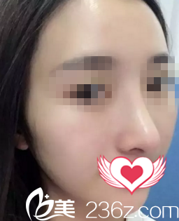 看我找海口鹏爱张淑艳做的鼻综合一个月后，侧颜挺挺的线条感超强