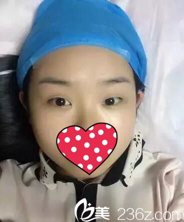 做双眼皮术前一只眼大一只眼小 做双眼皮术前一只眼大一只眼小