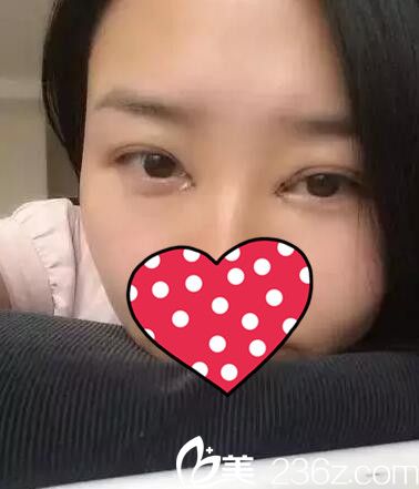 眼综合术后三天恢复 眼综合术后三天恢复