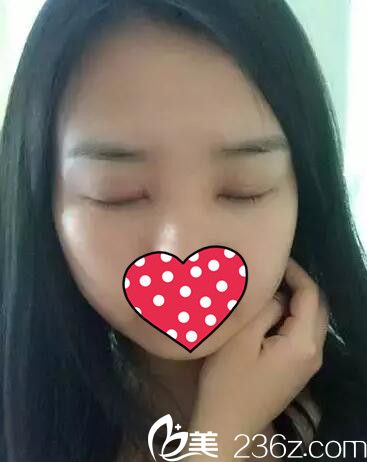 拆线后双眼皮效果 拆线后双眼皮效果