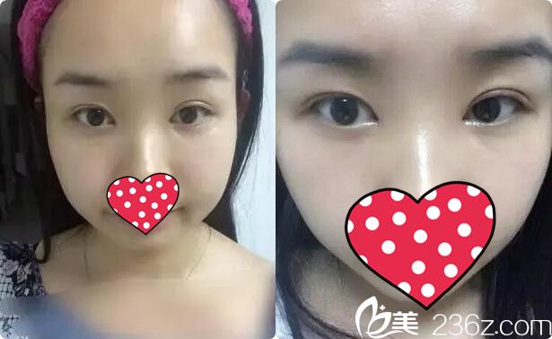 双眼皮+开眼角术后十天 双眼皮+开眼角术后十天