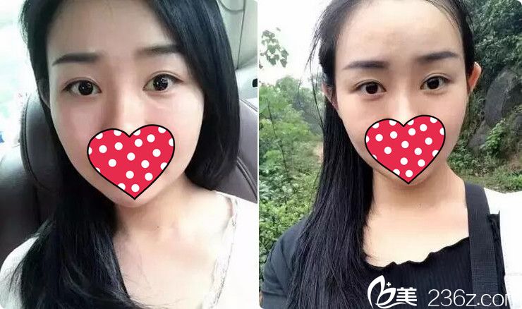 找无锡施尔美王章霞做双眼皮+开眼角眼综合9800元是不是贵了