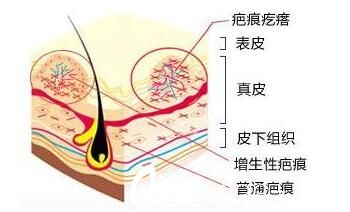 南宁韩星整形医院医生讲解疤痕分类