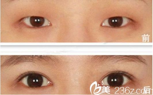 兰州亚韩谢雯双眼皮整形效果
