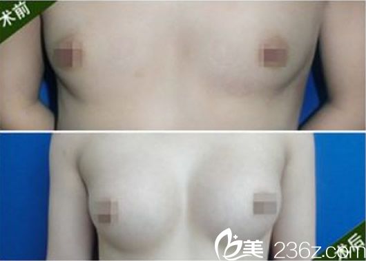 兰州亚韩徐陇豫隆胸整形案例