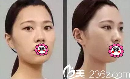 在南宁韩星做眼鼻综合+自体脂肪填充全脸前 在南宁韩星做眼鼻综合+自体脂肪填充全脸前