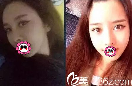 在南宁韩星找院长花87900元做眼鼻综合+自体脂肪填充全面部过程