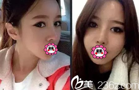 在南宁韩星做眼鼻综合+自体脂肪填充全脸术后1个月 在南宁韩星做眼鼻综合+自体脂肪填充全脸术后1个月