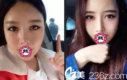 在南宁韩星做眼鼻综合+自体脂肪填充全脸术后2个月 在南宁韩星做眼鼻综合+自体脂肪填充全脸术后2个月