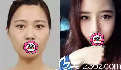 在南宁韩星做眼鼻综合+自体脂肪填充全脸术前术后对比