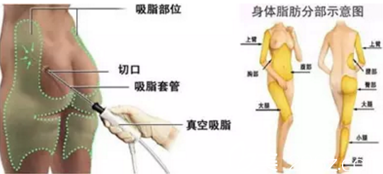 南宁韩星吸脂塑形适合全身部位 南宁韩星吸脂塑形适合全身部位
