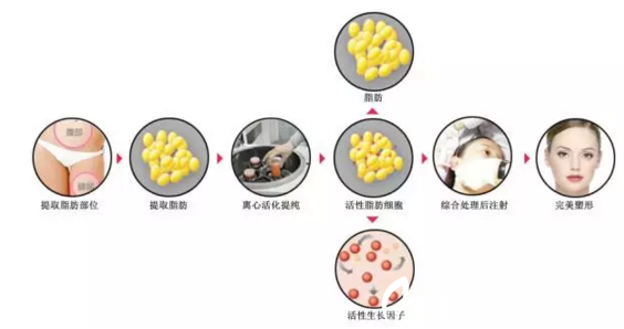 南宁韩星自体脂肪填充过程 南宁韩星自体脂肪填充过程