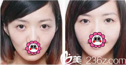 南宁韩星自体脂肪填充案例 南宁韩星自体脂肪填充案例