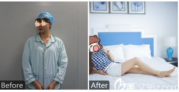 广州瑞港医疗整形美容医院黄其然医生吸脂案例