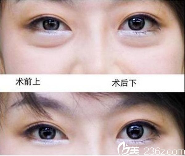 姜昌均院长祛眼袋手术案例