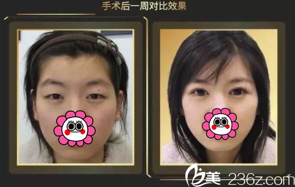 张东波医生双眼皮案例 张东波医生双眼皮案例