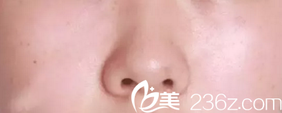 鼻形困扰之一蒜头鼻