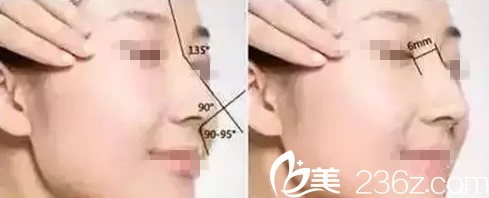 刘鼻整形技术特点