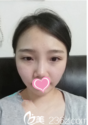 韩国COWELL整形外科手术前 韩国COWELL整形外科手术前