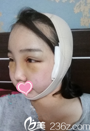 手术后第3天 手术后第3天