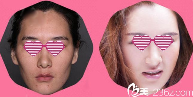 温州芘丽芙自体脂肪填充案例 温州芘丽芙自体脂肪填充案例