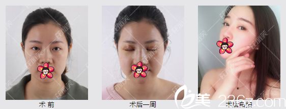 刘翠竹玻尿酸隆鼻和填充全脸案例 刘翠竹玻尿酸隆鼻和填充全脸案例