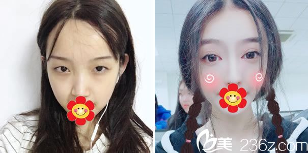 温州芘丽芙金锋医生眼鼻手术代表案例