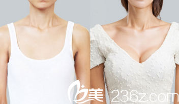 胸部整形前后对比