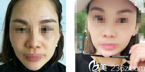 兰州明伦关欣激光祛黄褐斑效果 兰州明伦关欣激光祛黄褐斑效果