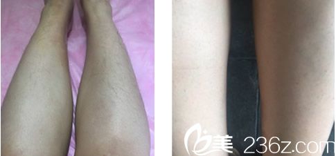 兰州明伦激光脱毛案例 兰州明伦激光脱毛案例