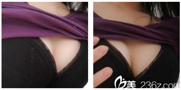 深圳瑞港医疗美容隆胸还挺靠谱的,不信来看医学博士孙瑞霞做的脂肪丰胸效果