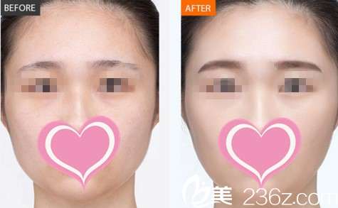 面部年轻化真人对比 面部年轻化真人对比