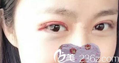 郑州一美双眼皮手术当天 郑州一美双眼皮手术当天