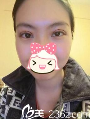 郑州一美双眼皮手术后3天 郑州一美双眼皮手术后3天