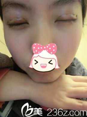 一美双眼皮手术后三天闭眼照