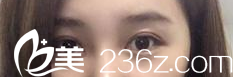 花一万多做的自然无痕韩式三点双眼皮，看我在北京301医院变美了