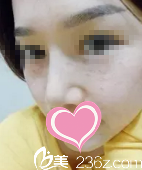 术前正面照 术前正面照