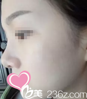 术后侧颜效果 术后侧颜效果