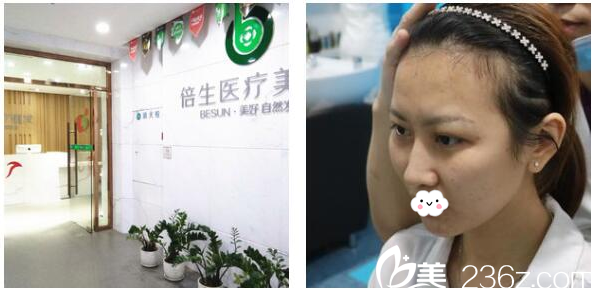 来到广州倍生植发医院