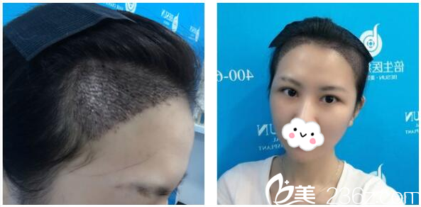 找广州倍生植发医院廖骏植发第4天