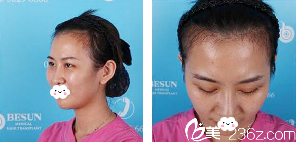 广州倍生植发医院发际线种植2个月